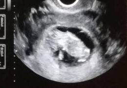 11 Weeks 2 Days Pregnant Ultrasound Twins