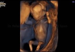 13-Week Fetus Moving in 4D, Drawstring Shoulder, Awesome