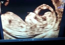 13 week ultrasound girl or boy ????