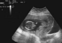 3 months baby ultrasound