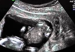 Gender Ultrasound 13 Weeks 4 Days! Confirmed GIRL